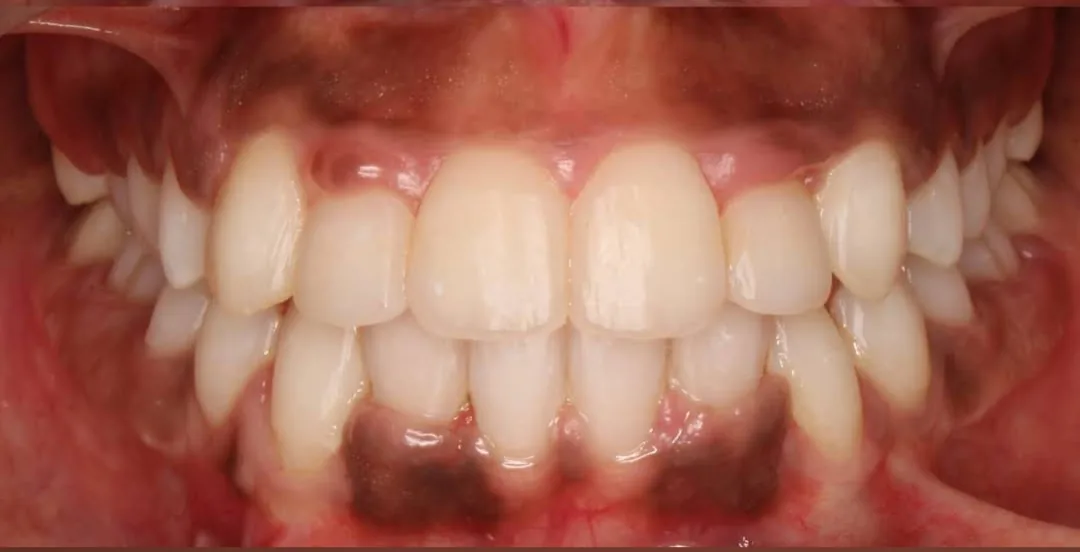 Before treatment